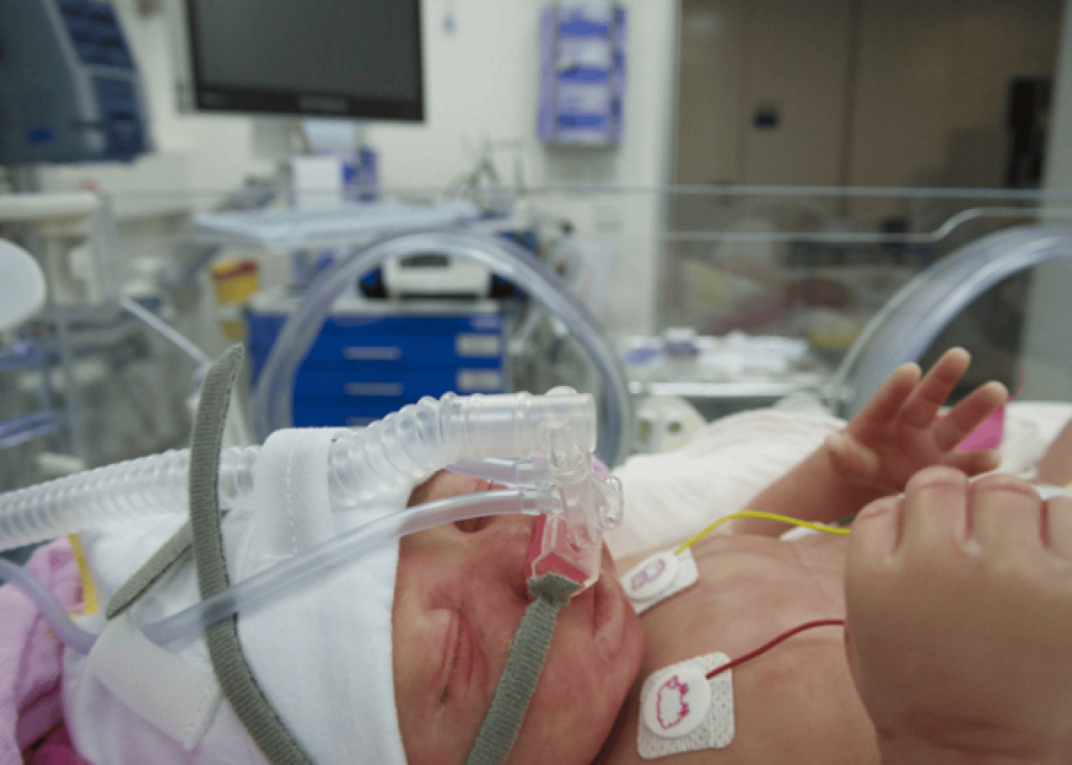 A newborn lies in an incubator with a breathing mask and monitoring cables in the neonatal intensive care unit (NICU) of a hospital. Medical equipment can be seen in the background.
