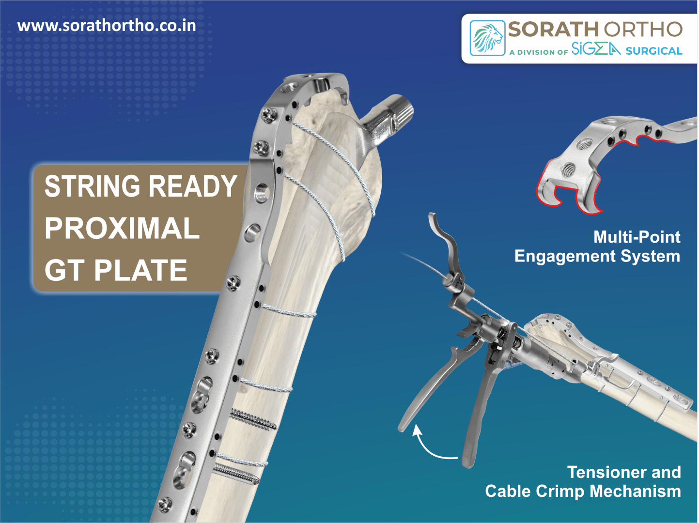 Illustration einer String Ready Proximal GT-Platte, die an einem Knochen befestigt ist, mit gekennzeichneten Merkmalen wie einem Mehrpunkt-Einrastsystem, einem Spanner und einem Kabelcrimpmechanismus. Das Logo und die Website von Sorath Ortho sind abgebildet.